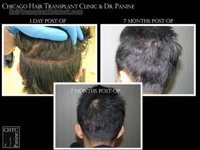 Hair transplantation surgery before and after pictures