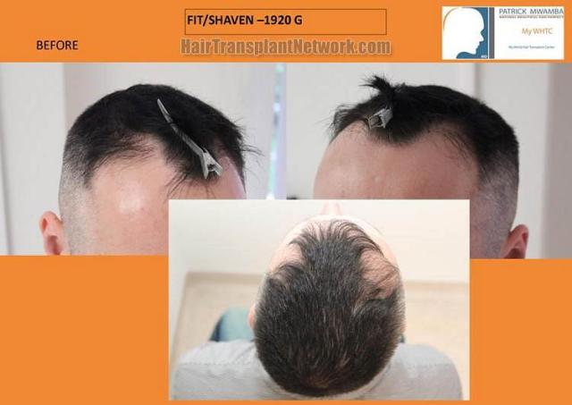 Hair transplantation surgery before and after pictures