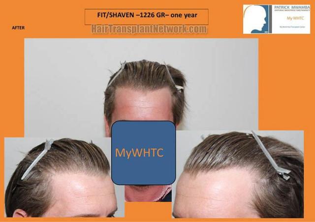 Hair restoration surgery before and after photos