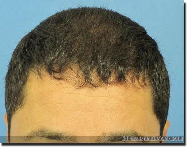 Hair restoration procedure results