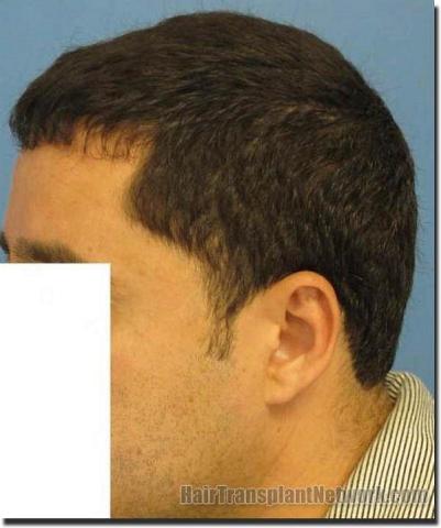 Hair restoration procedure results