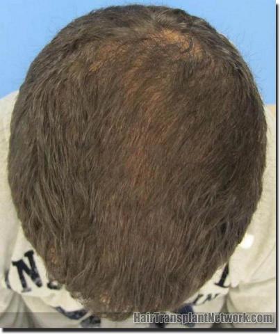 Hair restoration procedure results