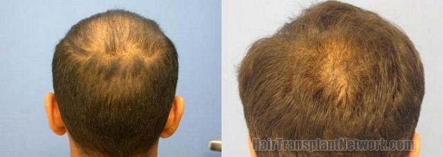 Back photos from 4200 graft hair replacement surgery