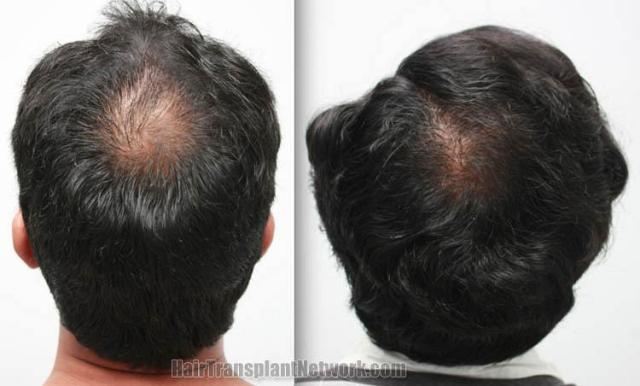 Hair restoration procedure before and after pictures