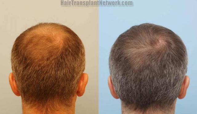 Hair transplantation surgery before and after photos