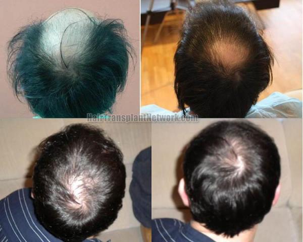 Hair restoration procedure before and after pictures