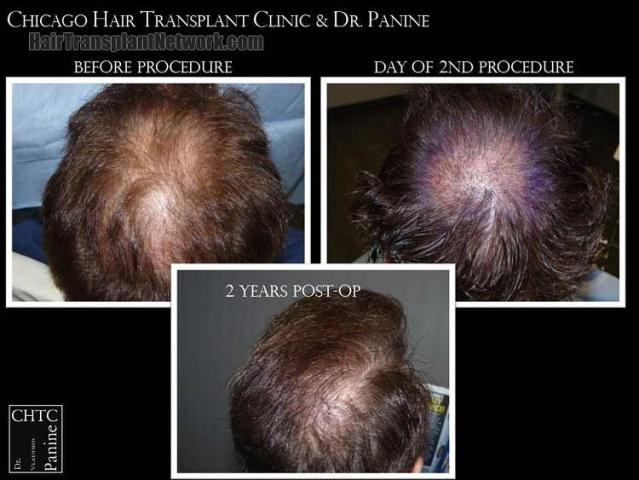 Hair restoration procedure before and after pictures