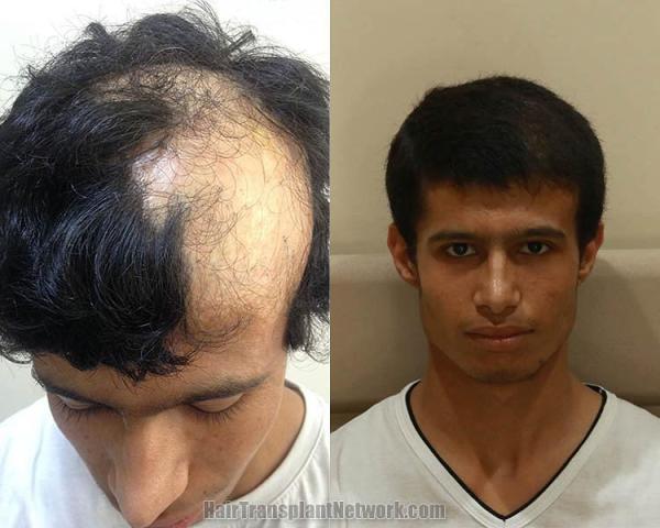 Hair transplantation surgery before and after images