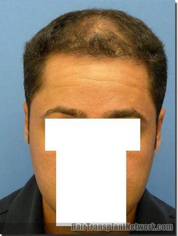 Hair restoration procedure results