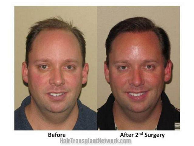 Hair transplant results - Front view - Two sessions