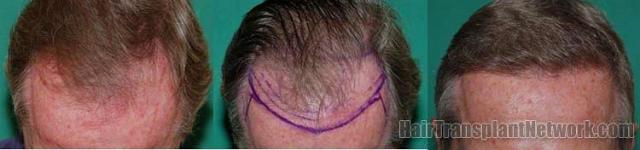 Hair transplant results showing frontal view