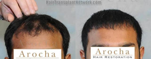 Hair restoration procedure before and after results