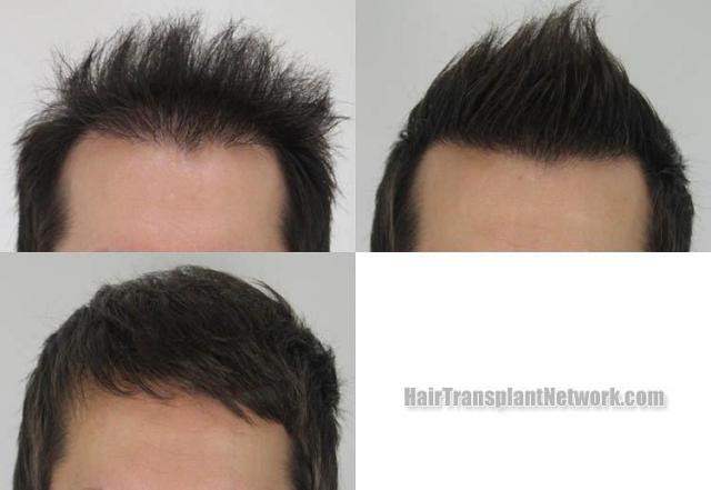 Hair transplantation surgery before and after images