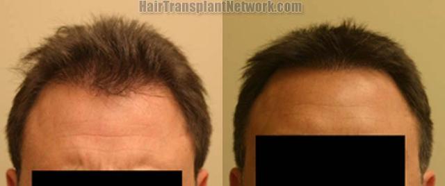 Hair restoration procedure before and after results