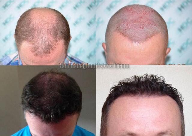 Hair restoration procedure before and after results