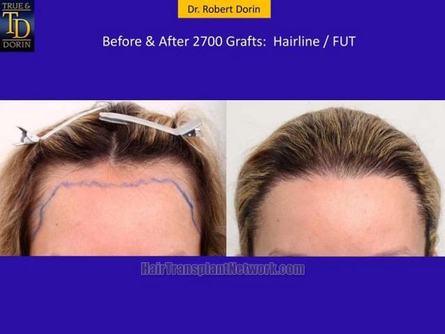 Hair transplantation surgery before and after photos