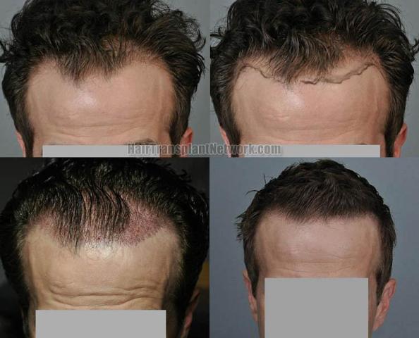 Hair restoration procedure before and after results