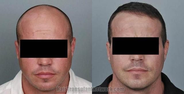 Hair restoration procedure before and after results