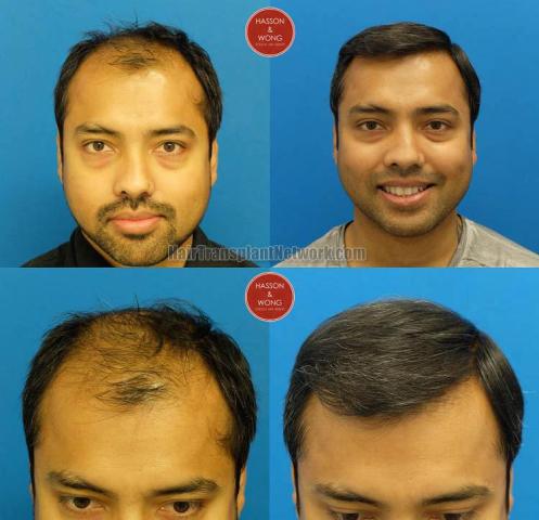 Hair restoration procedure before and after results