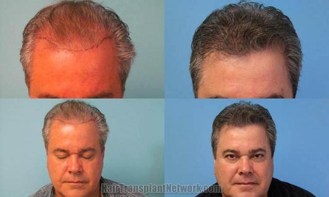 Hair transplantation surgery before and after photos