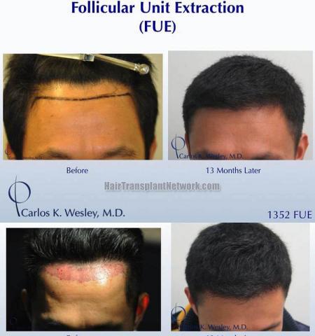 Hair restoration procedure before and after pictures