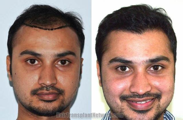 Before and after hair transplant procedure images