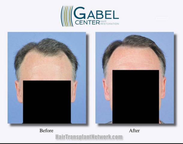 Hair restoration procedure before and after results