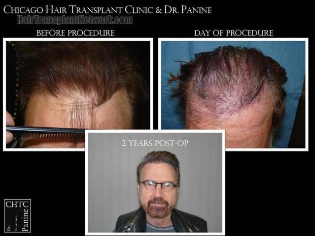 Hair transplantation surgery before and after pictures