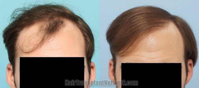 Hair restoration procedure before and after results