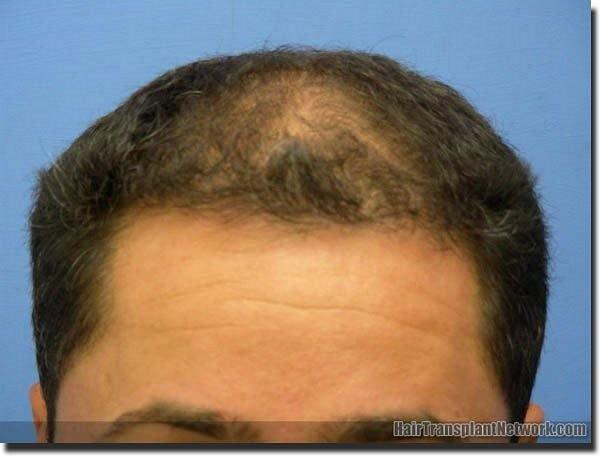 Hair restoration procedure results