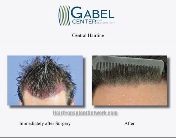 Hair restoration procedure before and after results