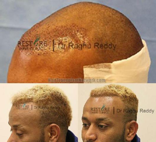 Hair transplantation surgery before and after pictures