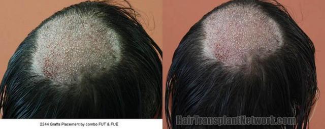 Hair transplantation surgery before and after pictures