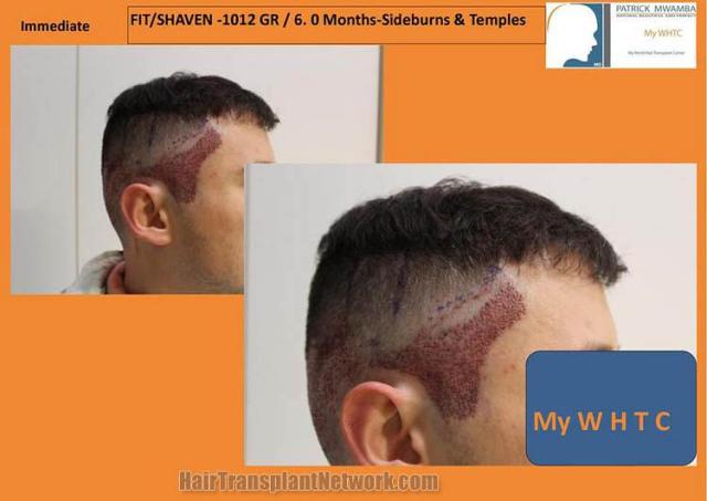 Hair restoration surgery immediate postoperative images