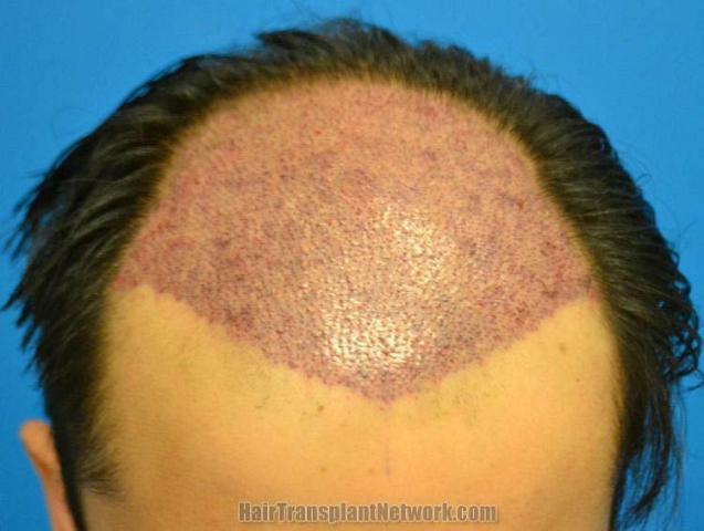 Hair transplant surgery before and after photos