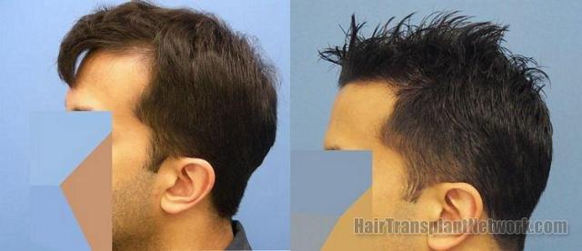 Left side profile view before and after hair transplant