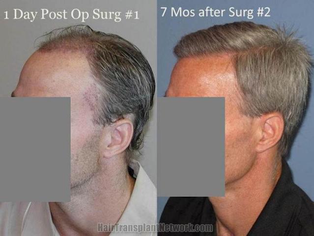 Hair transplantation surgery before and after photos