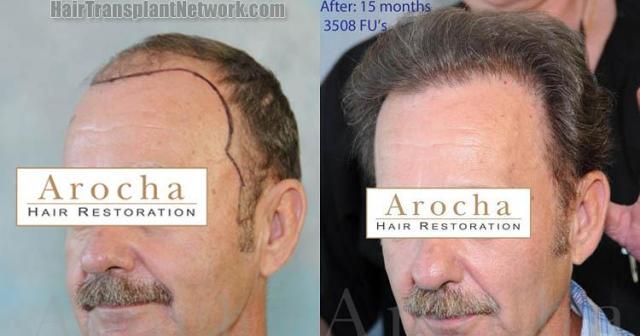 Hair transplantation surgery before and after images