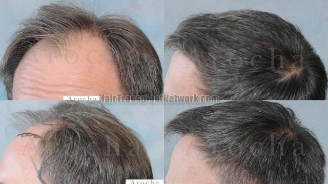 Hair transplantation surgery before and after images