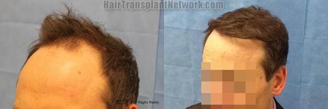 Hair restoration procedure before and after pictures