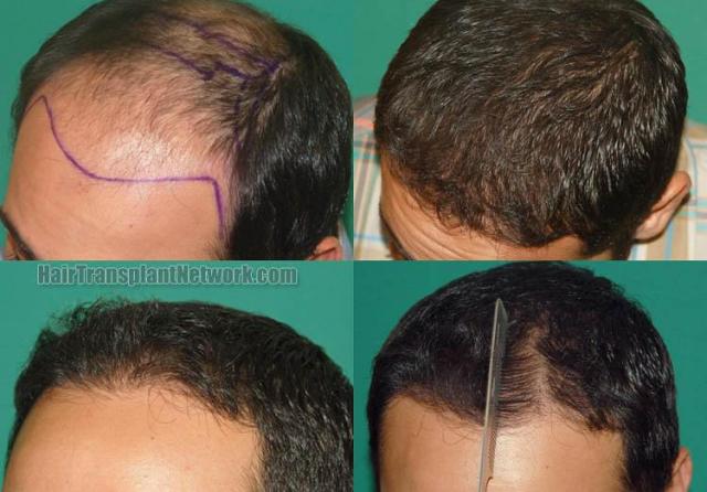 Hair transplantation surgery before and after pictures