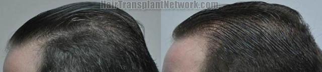 Hair transplantation surgery before and after images