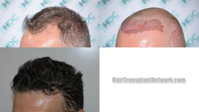 Hair transplantation surgery before and after images