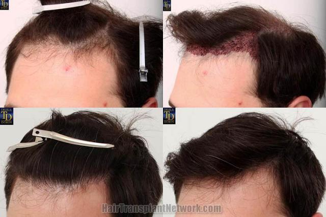 Hair transplantation surgery before and after images