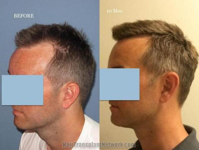 Hair transplantation surgery before and after pictures