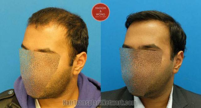 Hair transplantation surgery before and after pictures