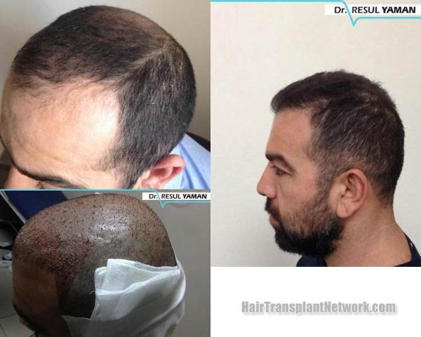 Hair restoration procedure before and after pictures