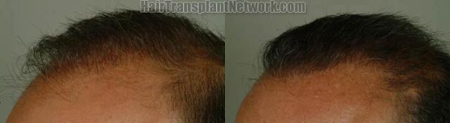 Hair restoration procedure before and after results