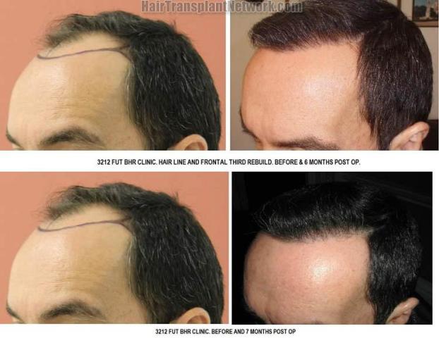 Hair restoration procedure before and after pictures