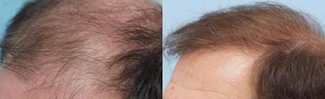 Hair transplantation surgery before and after pictures